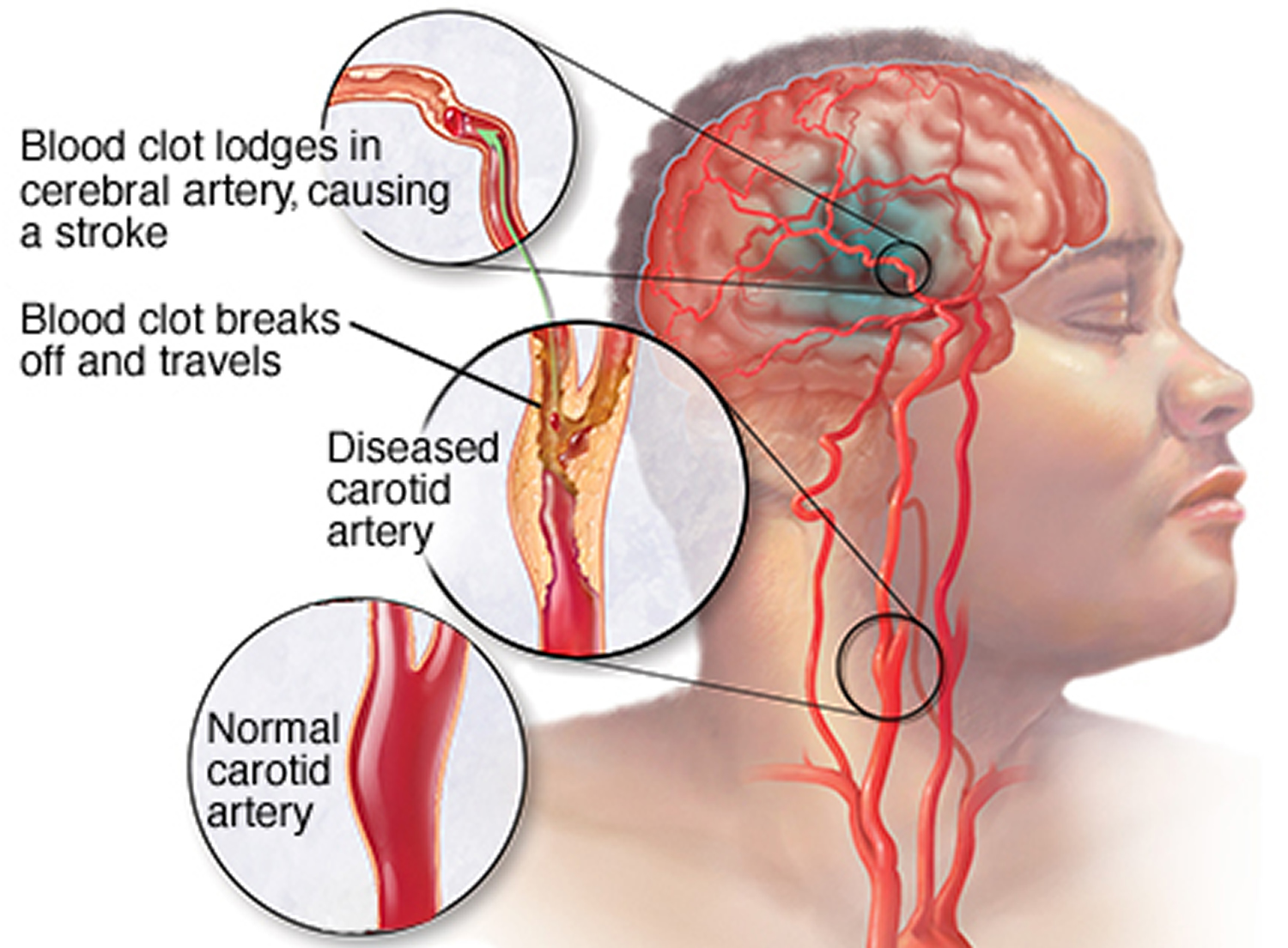Apoplexy, cerebral apoplexy, pituitary apoplexy causes, symptoms