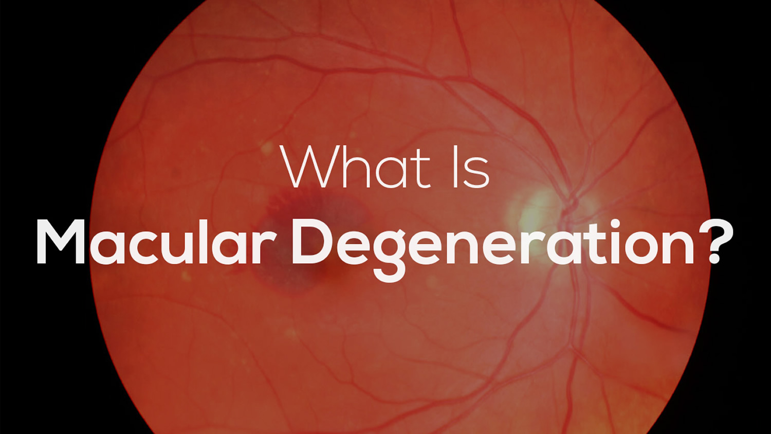 macular degeneration symptoms