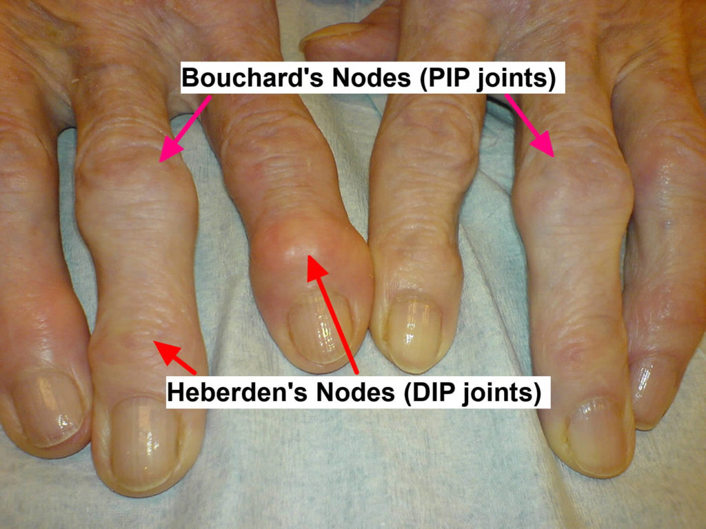 Osteoarthritis Causes, Symptoms, Diagnosis, Prognosis & Treatment