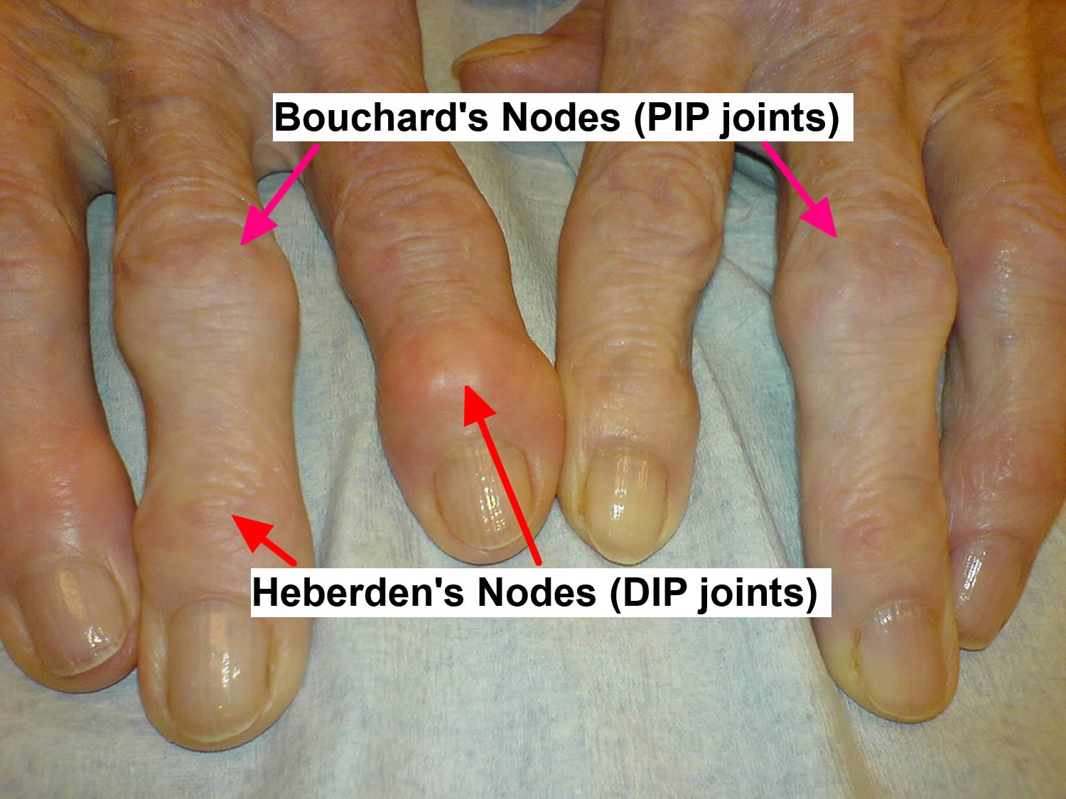 What Causes Arthritis Bumps On Fingers At Denise Osborne Blog