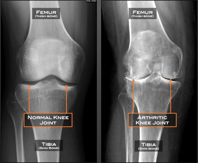 Osteoarthritis - Causes, Symptoms, Diagnosis, Prognosis & Treatment