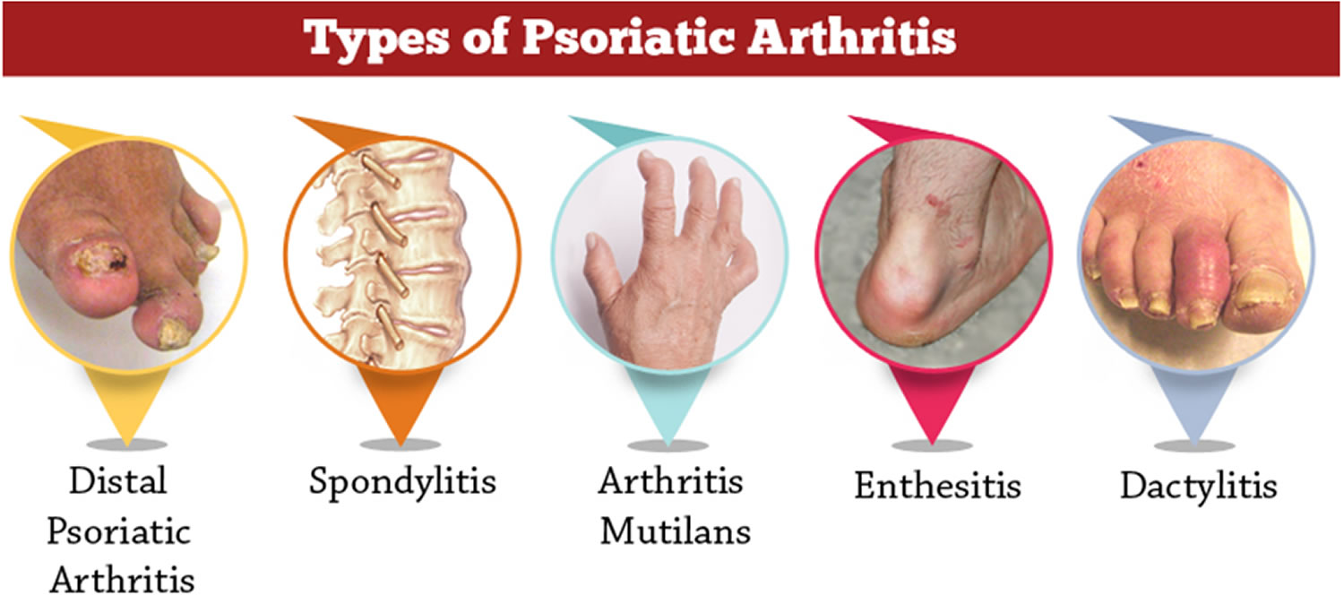 Psoriatic what arthritis causes What Causes
