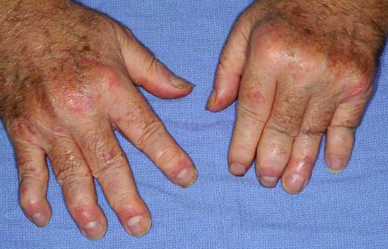 Psoriatic Arthritis Causes Symptoms Diagnosis Diet Treatment   Psoriatic Arthritis Hand 2 768x494 