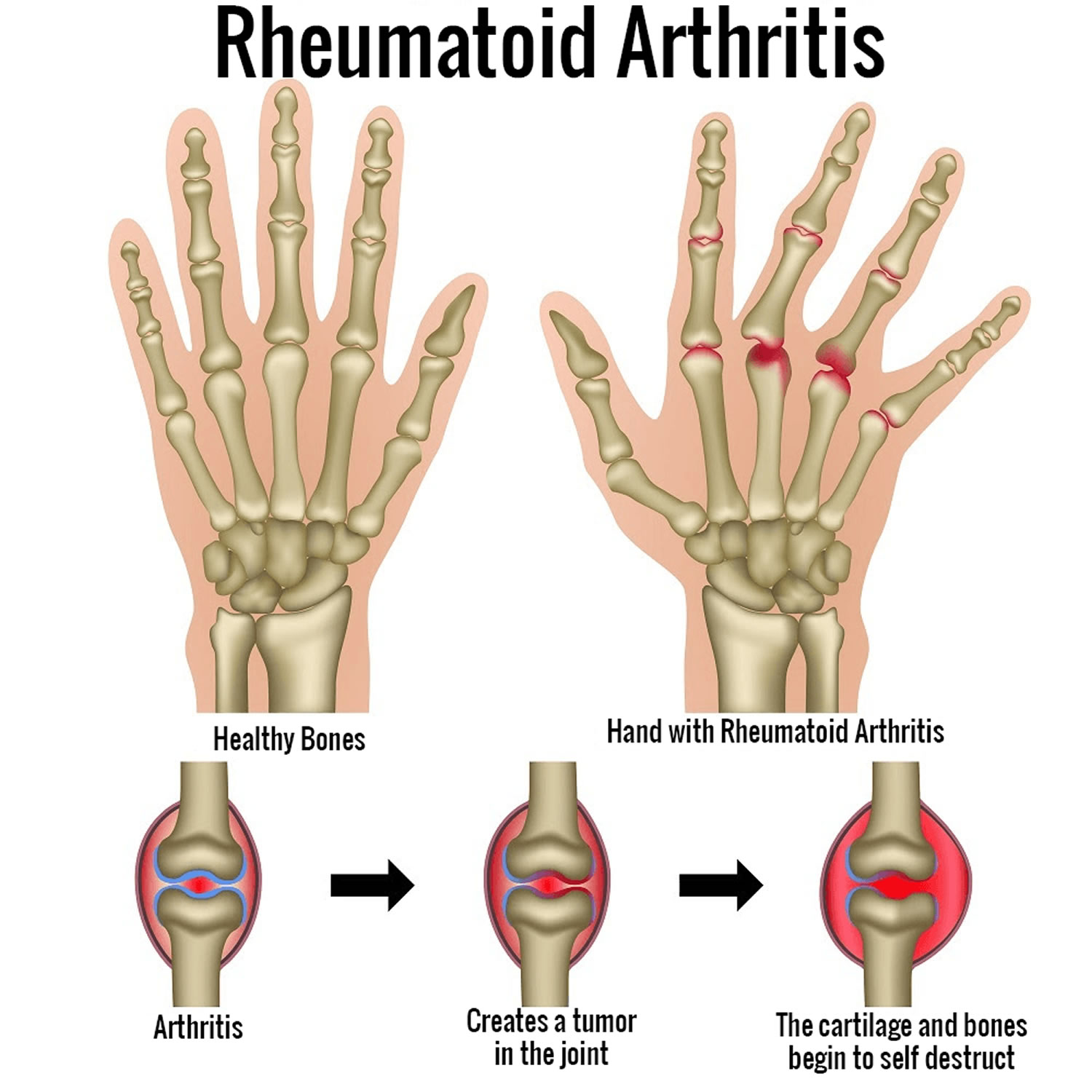 atypical presentation of rheumatoid arthritis