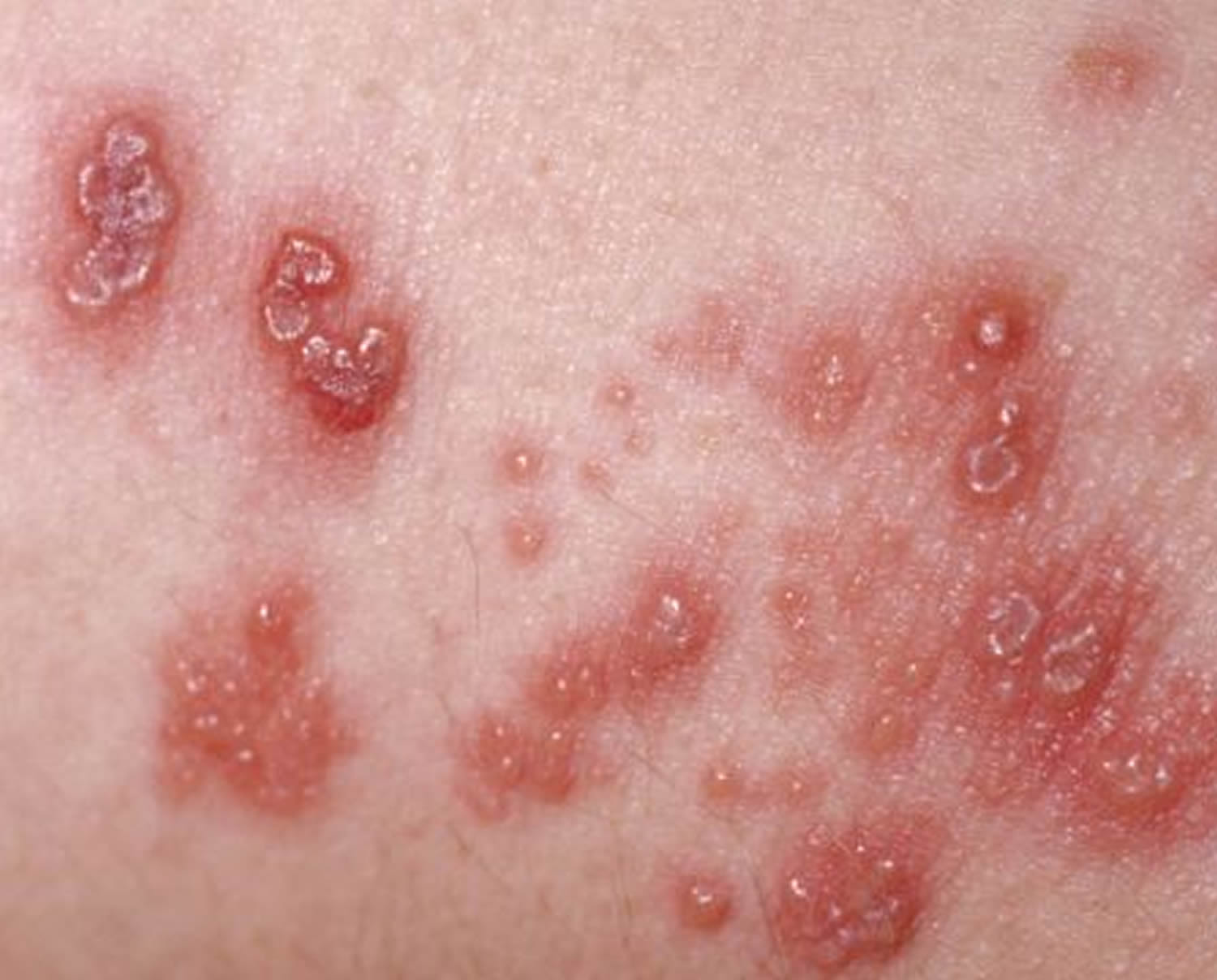 Shingles - Causes, Symptoms, Home Remedies, Treatment