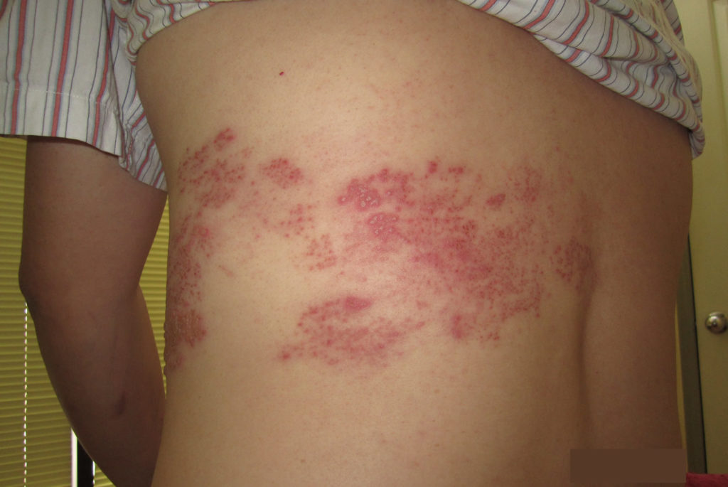 Shingles Causes, Symptoms, Home Remedies, Treatment