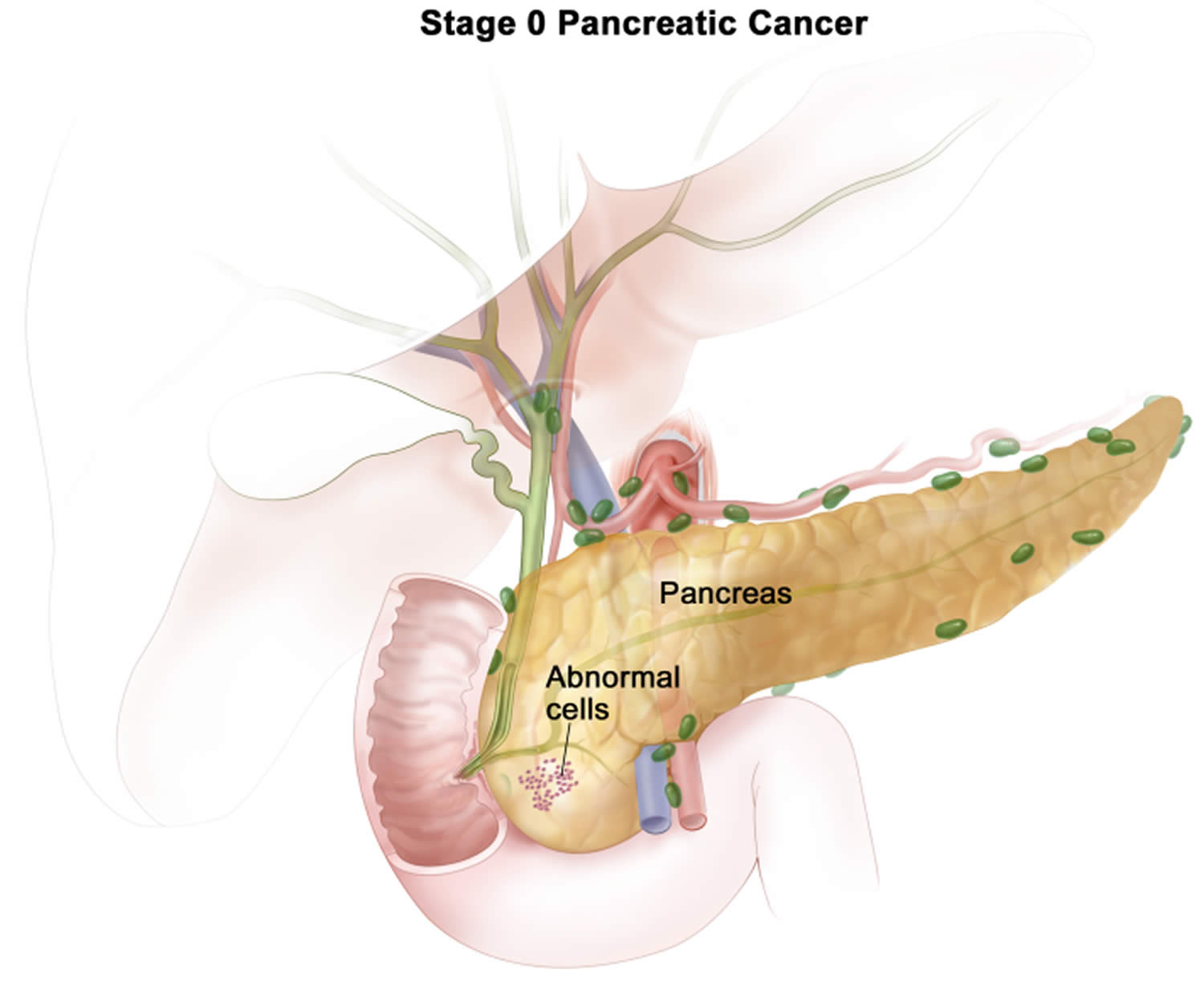 Stage 0 pancreatic cancer