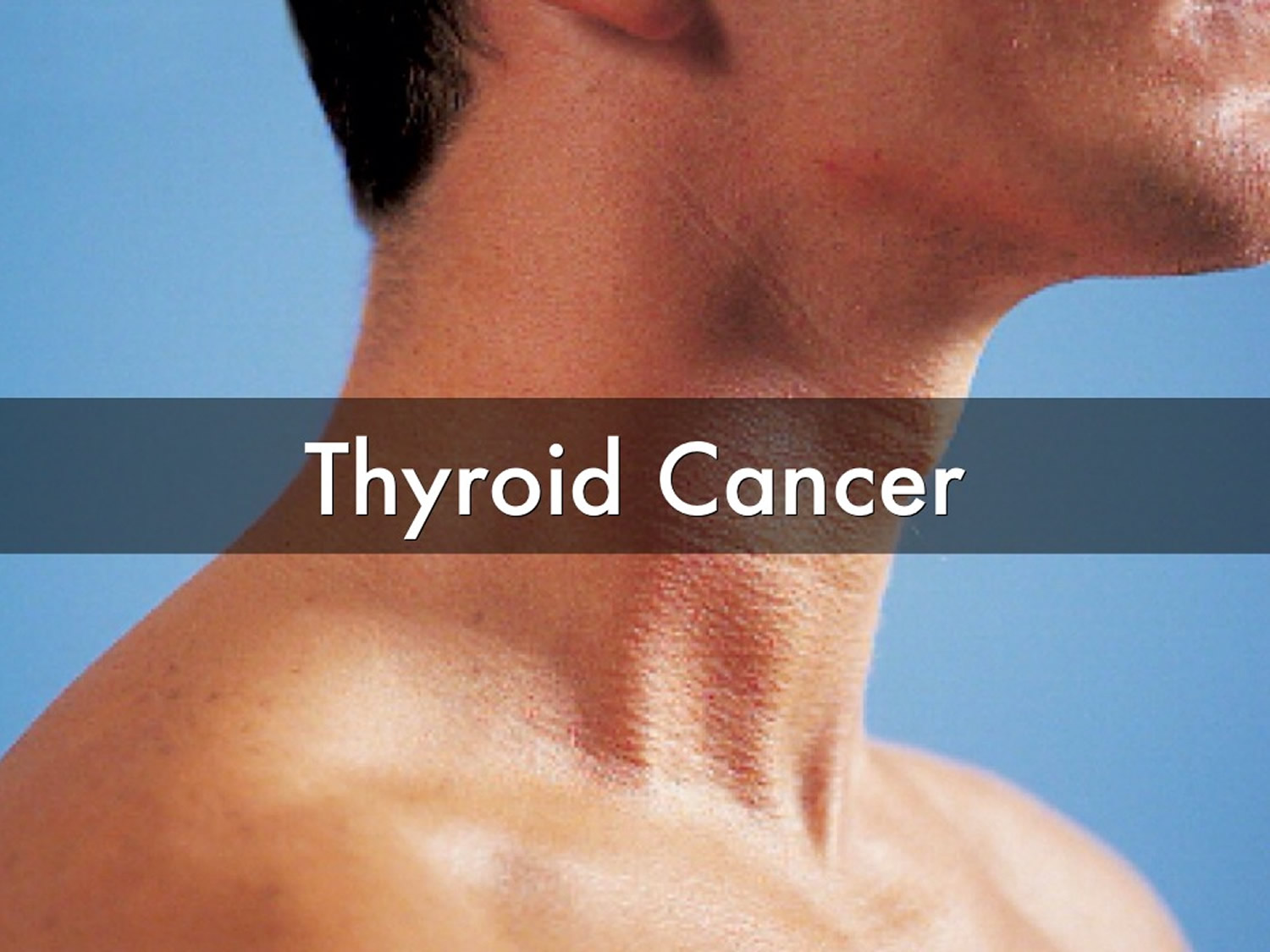 Thyroid Cancer Types Signs Symptoms Stages And Treatment