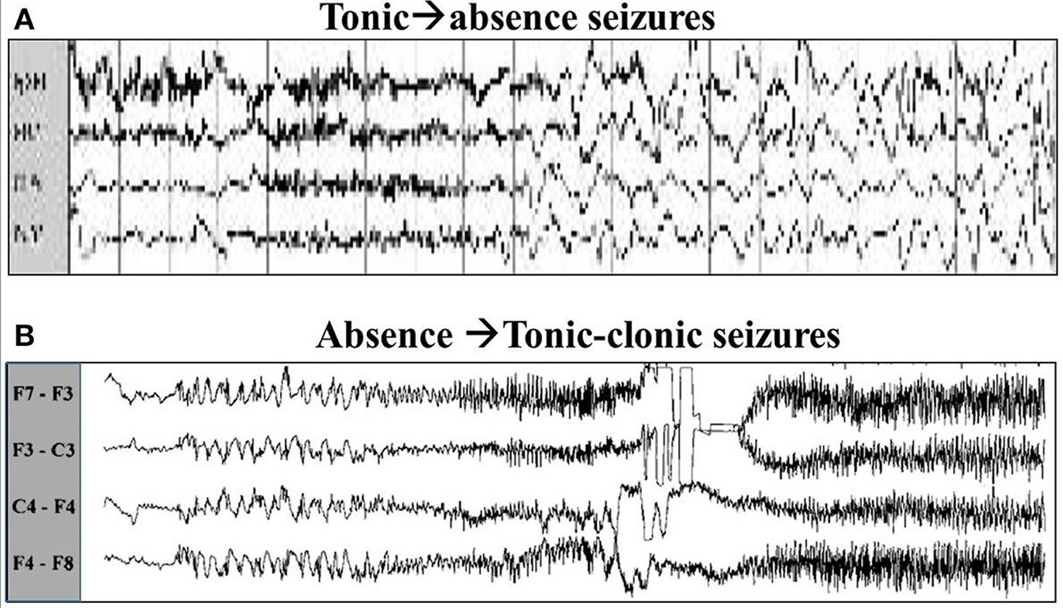 Absence seizures, causes, symptoms, diagnosis, treatment & prognosis