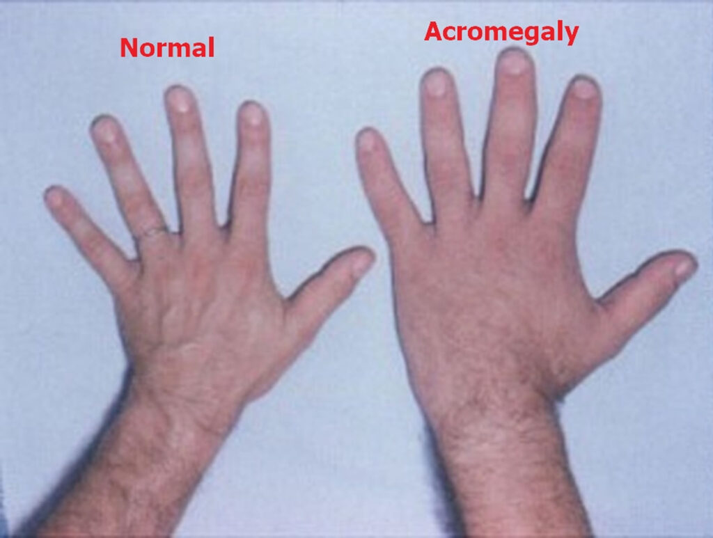 Acromegaly Gigantism vs Acromegaly Causes, Symptoms, Treatment