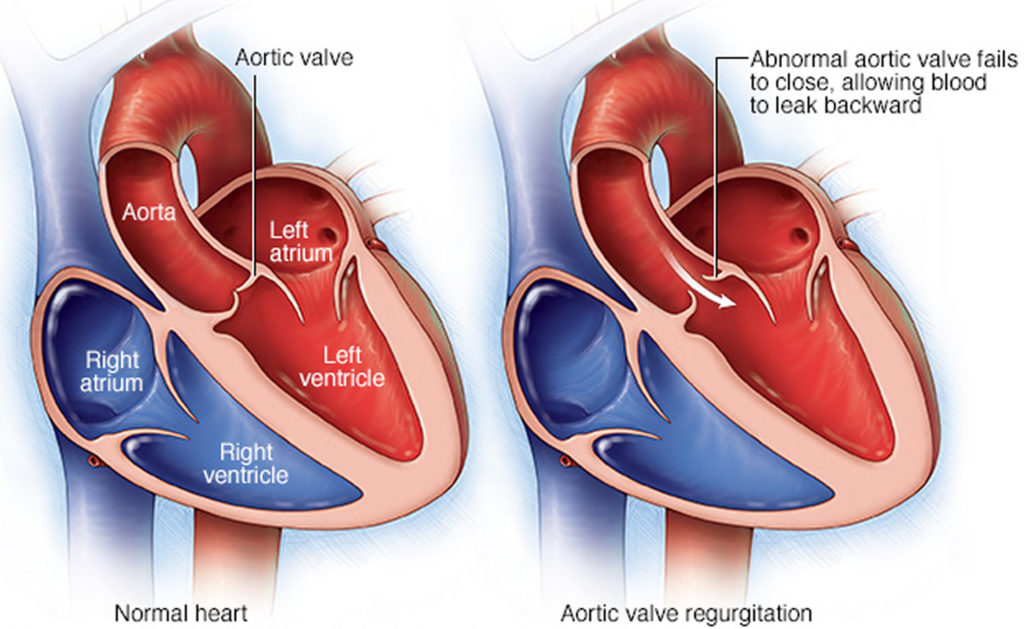 What Does A Bad Aortic Valve Feel Like