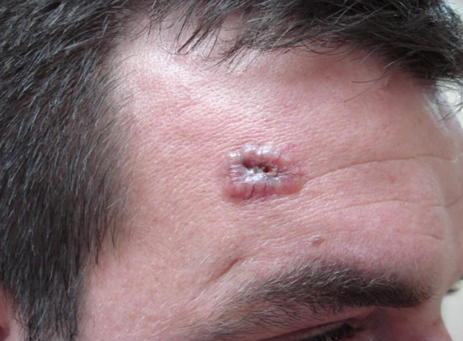 Basal Cell Carcinoma Causes Types Symptoms Prognosis Treatment