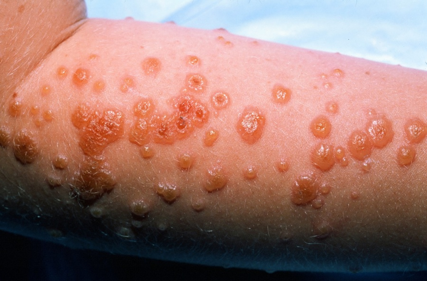 erythema-multiforme-steven-johnson-syndrome-toxic-epidermal-my-xxx