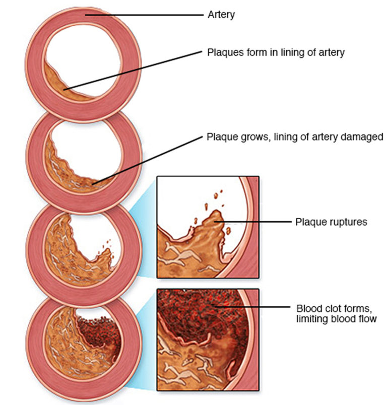 Myocardial Ischemia - Causes, Diagnosis, Symptoms, Treatment