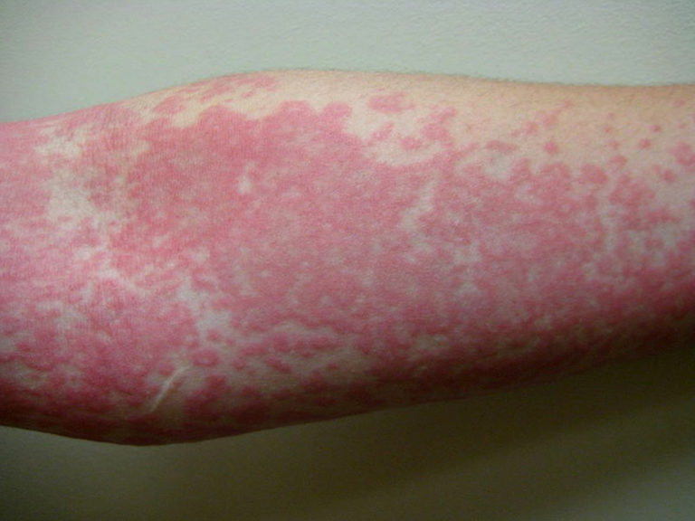 mold-allergy-skin-rash