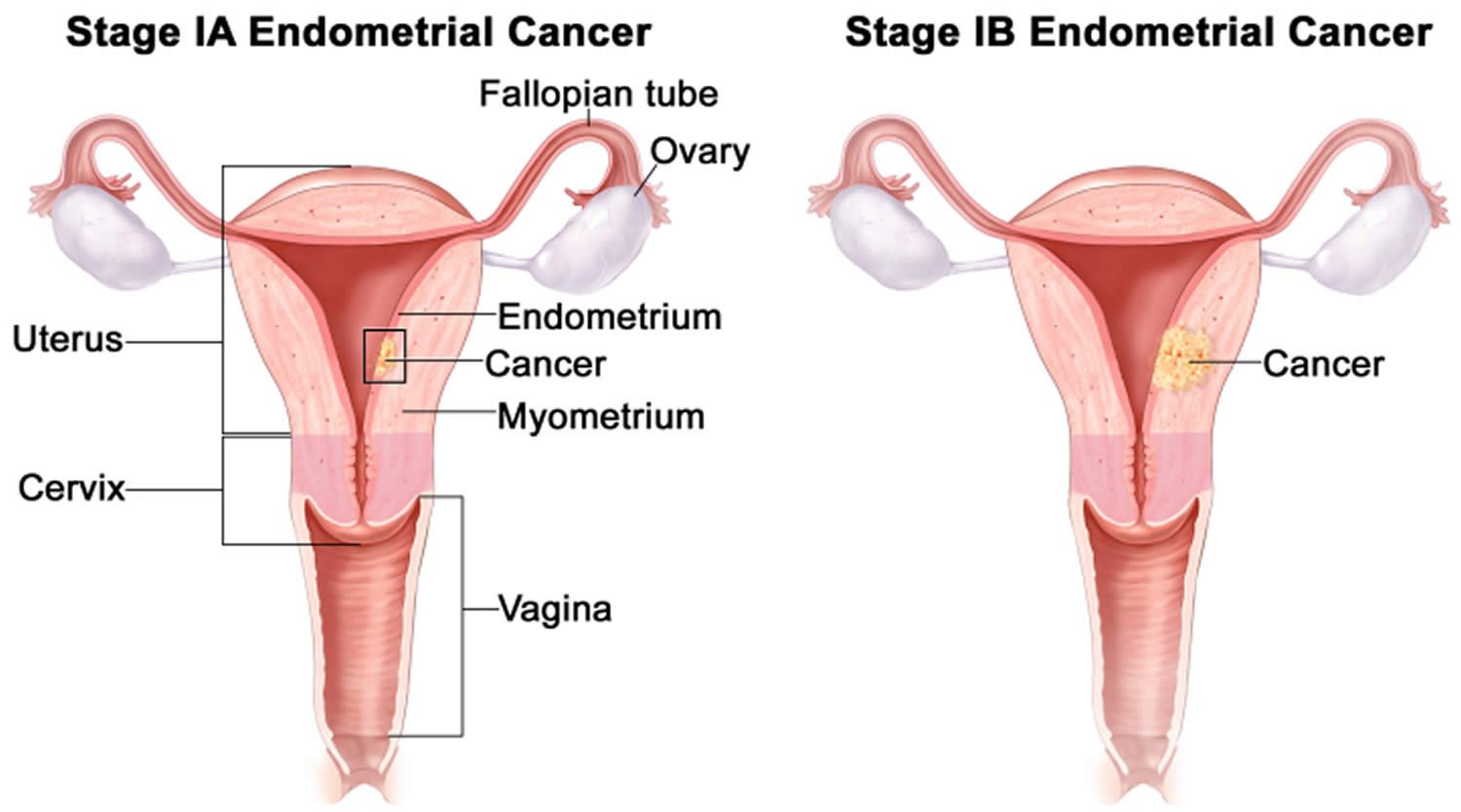 Stage 1 endometrial cancer