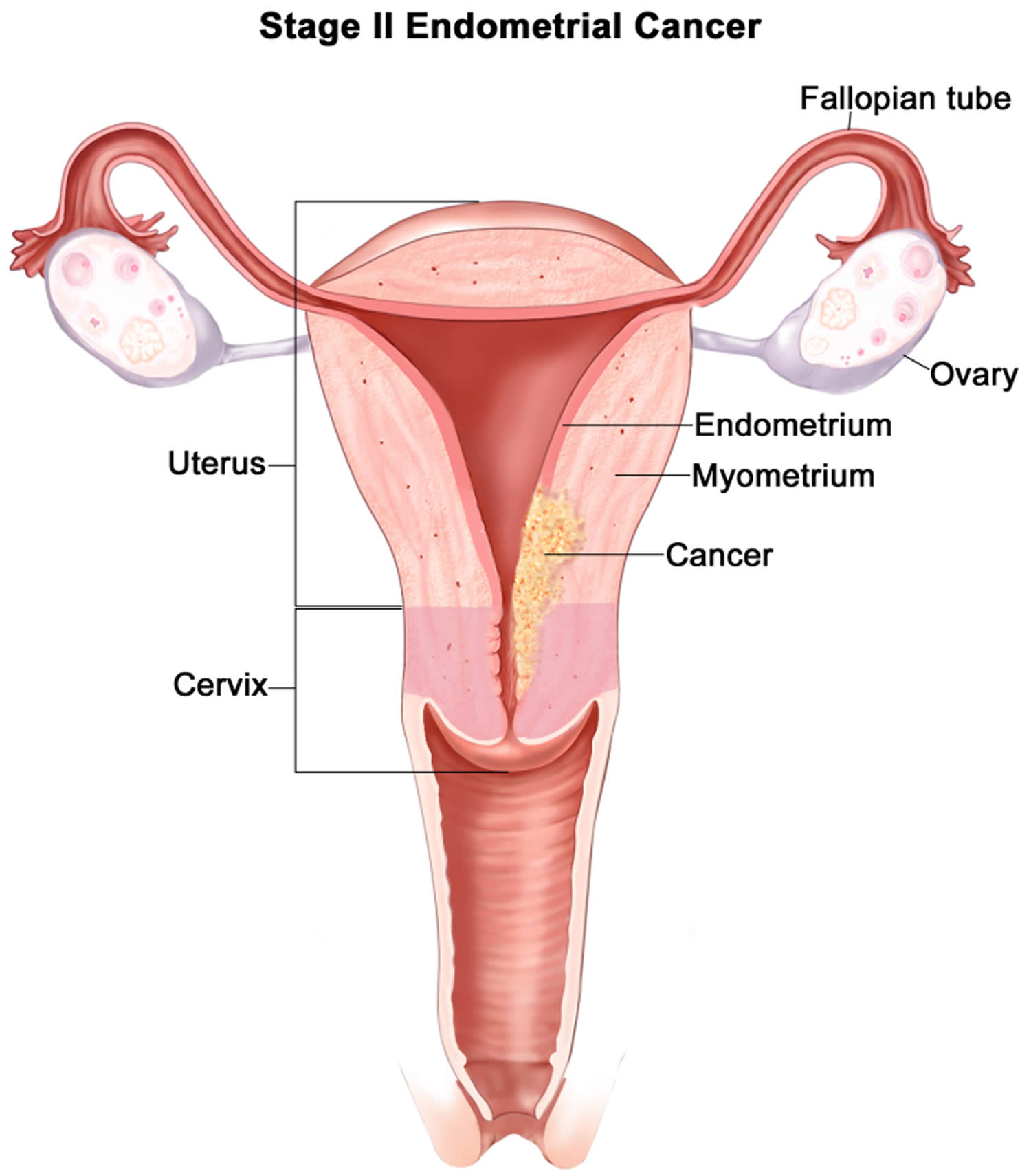 Stage 2 endometrial cancer