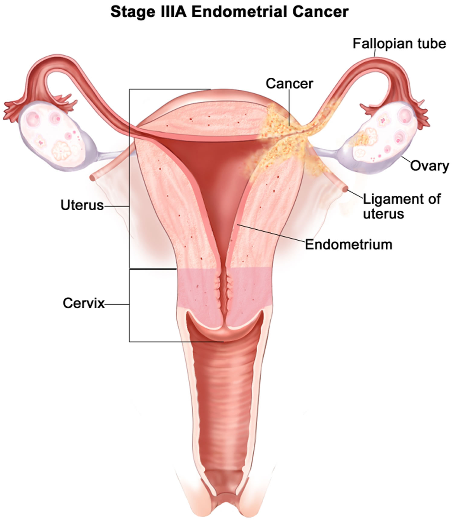 Stage 3A endometrial cancer