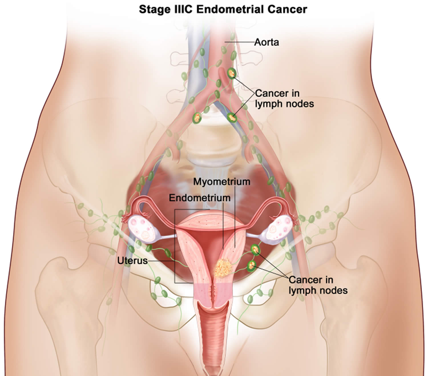 Stage 3C endometrial cancer
