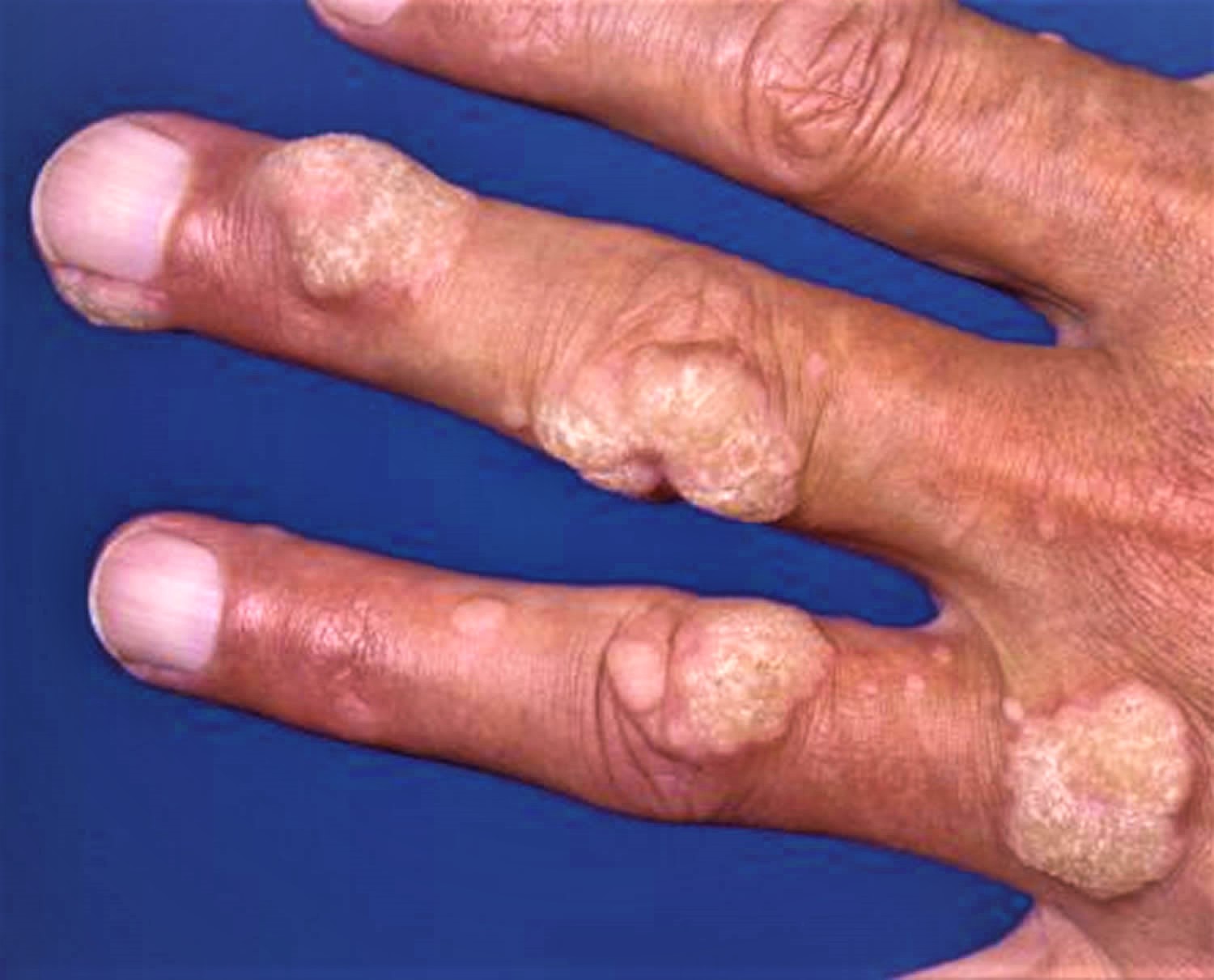 Warts Plantar Wart Wart On Finger Hands Face Wart Treatment