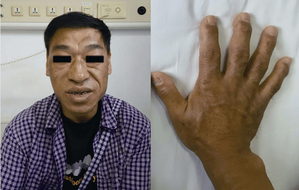 Acromegaly Gigantism Vs Acromegaly Causes Symptoms Treatment