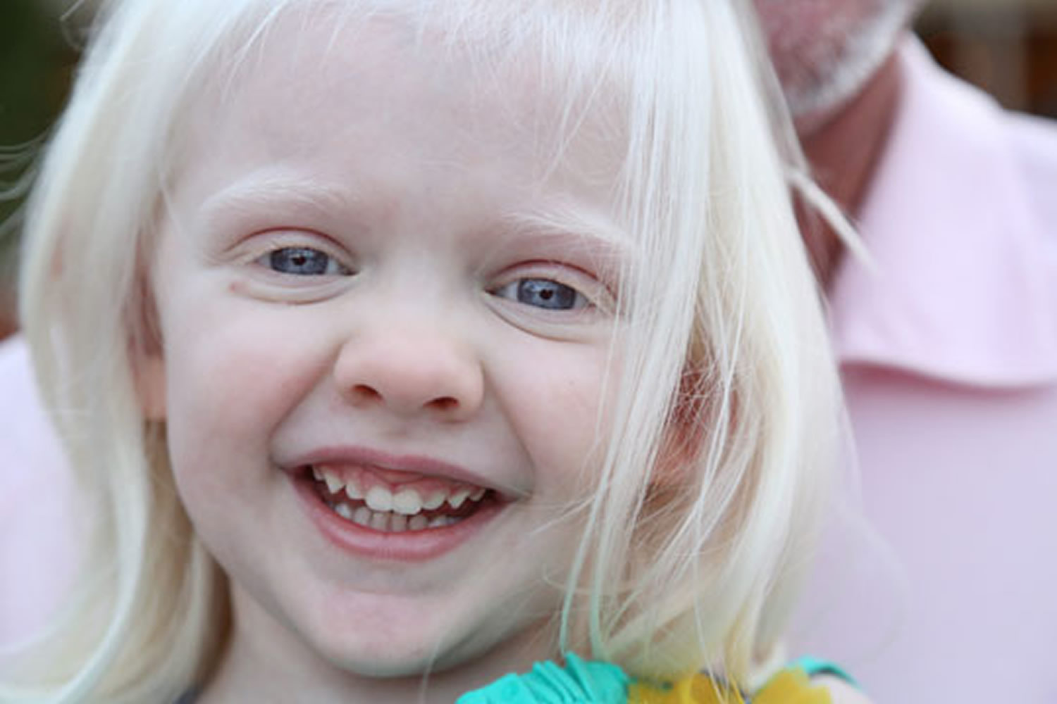 Albinism as related to Down Syndrome - Pictures