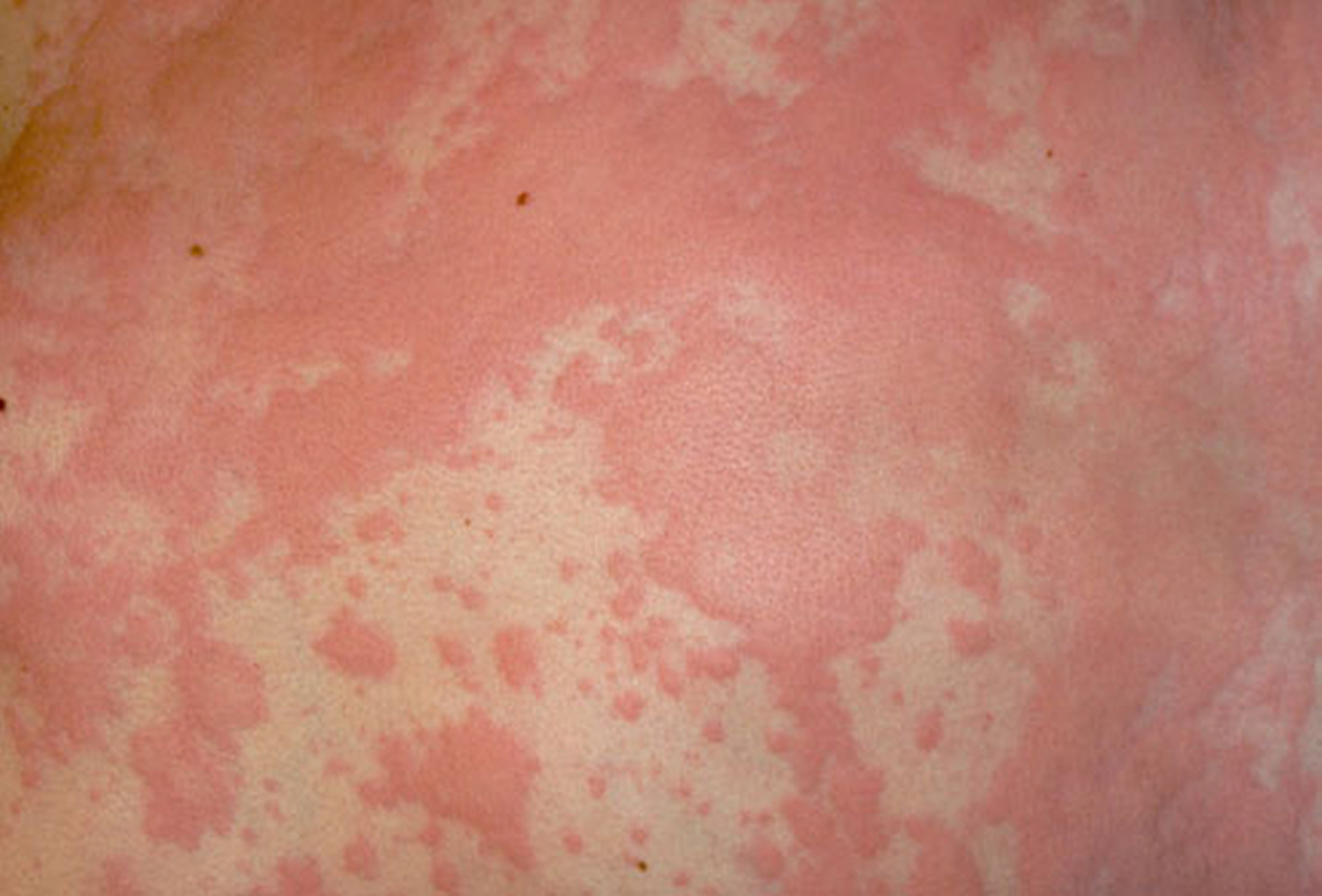 alcohol <b>allergy</b> rash.