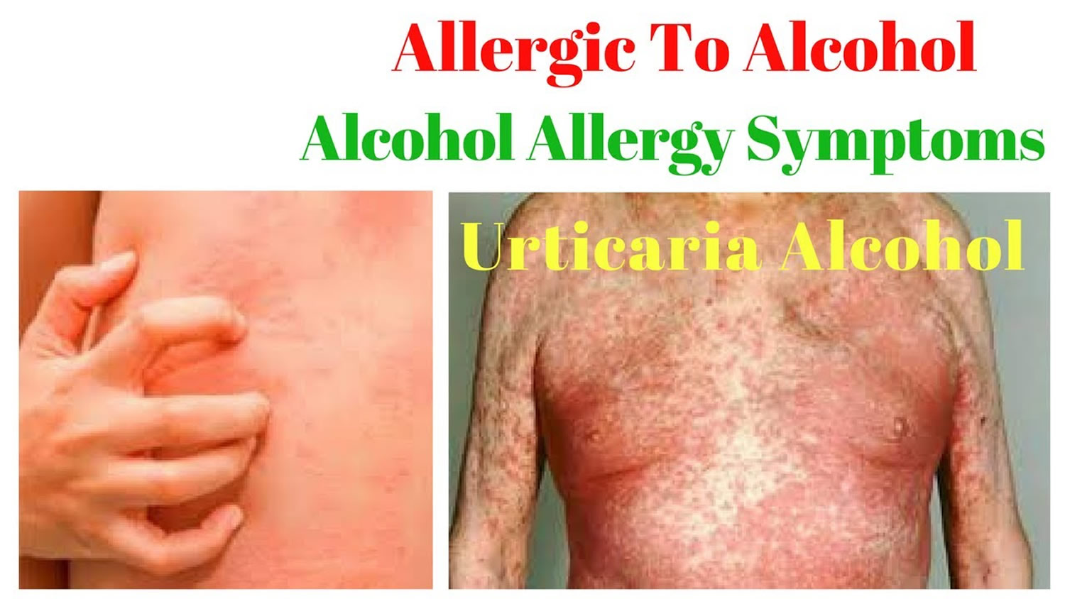 Alcohol allergy Symptoms, Rash, Alcohol Allergy Test & Treatment