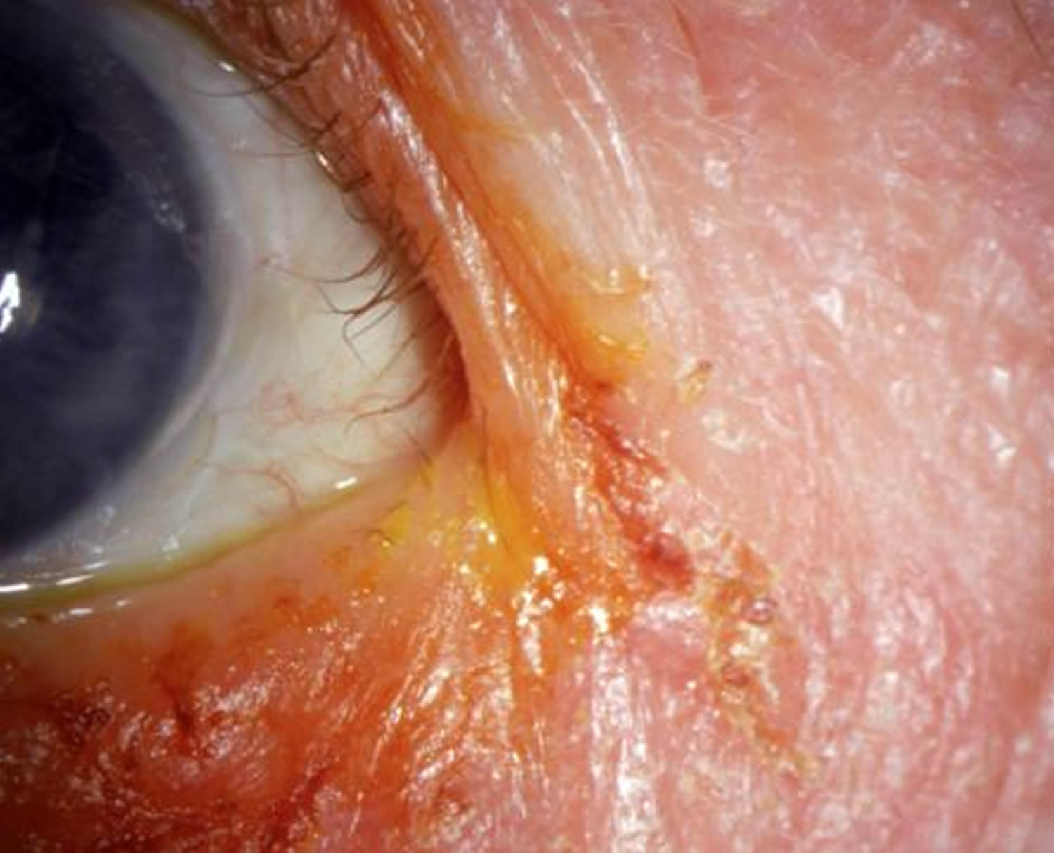 blepharitis