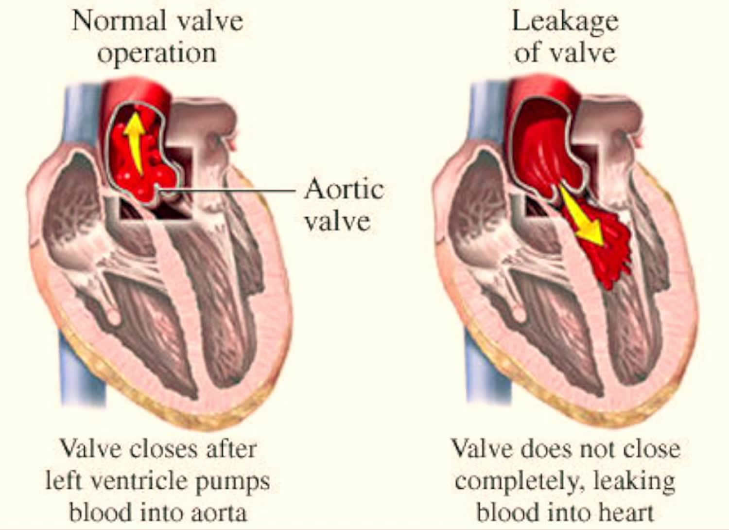 Is Trace Aortic Valve Regurgitation Normal