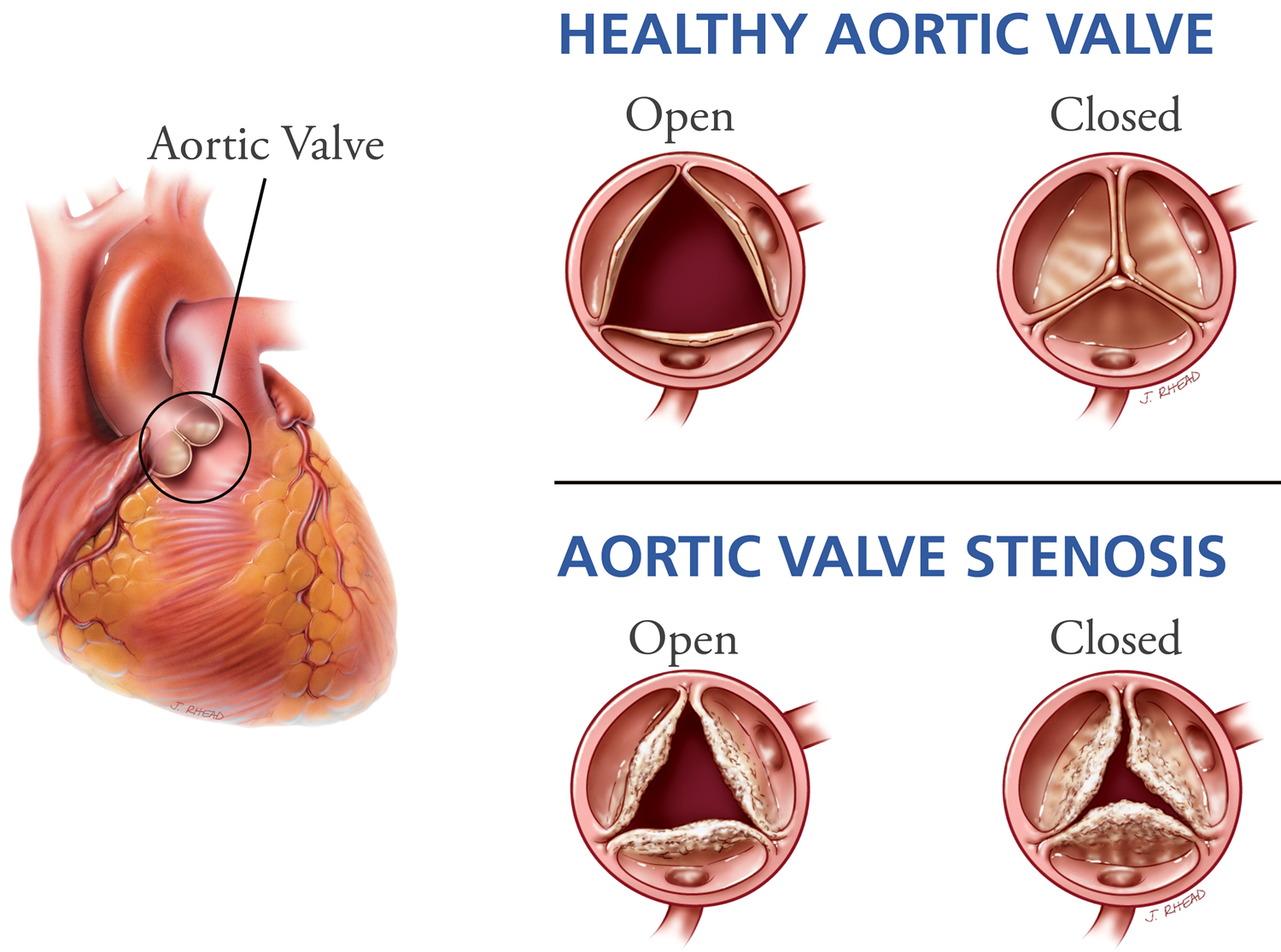 dhzb-aortic-valve-stenosis-aortic-valve-insufficiency