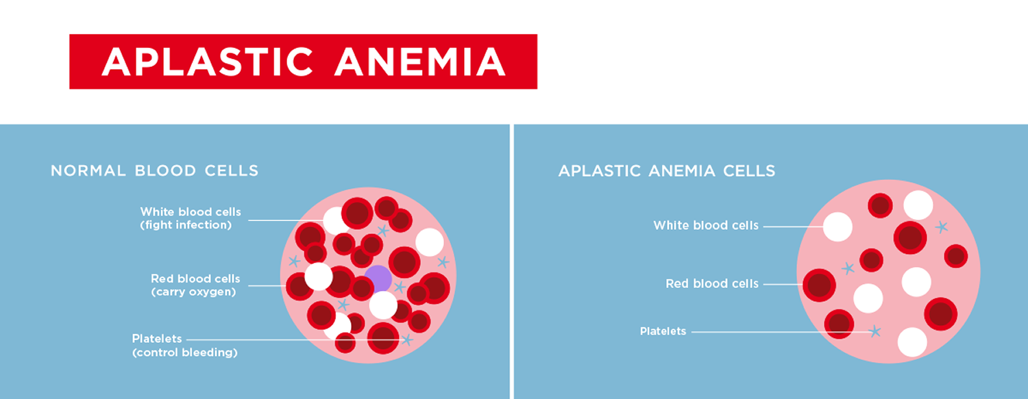 anemia aplastica tempo de vida