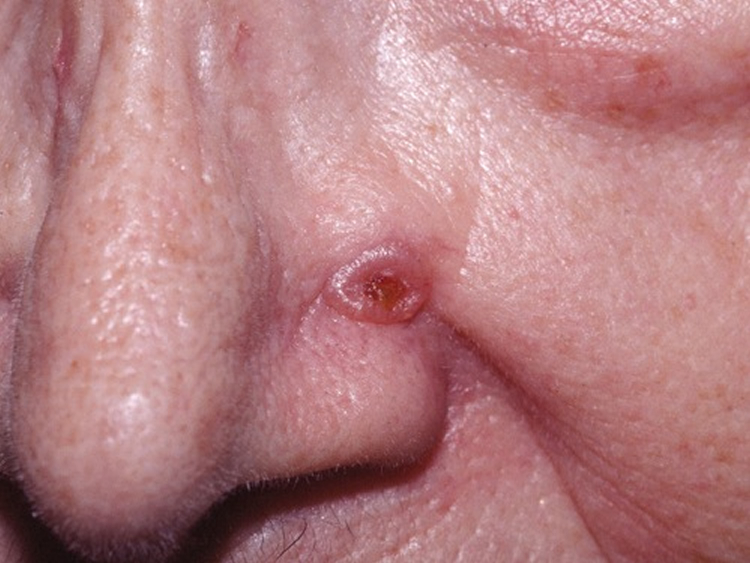 Basal Cell Carcinoma Causes Types Symptoms Prognosis Treatment