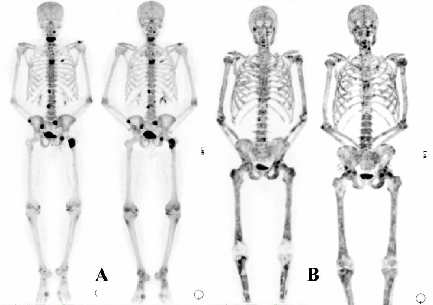 Bone Metastasis Cancer - Symptoms, Life Expectancy, Treatment