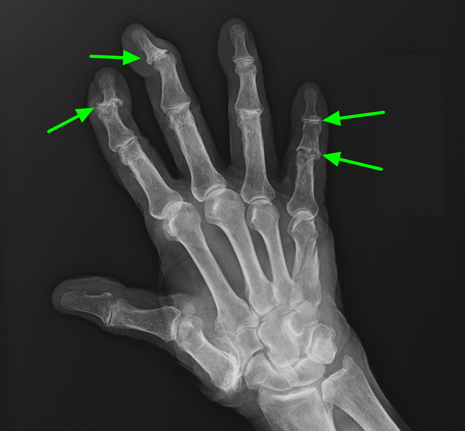 Ревматоидный артрит суставов кистей. Ревматоидный артрит кисти рентген. Ревматоидный артрит лучезапястного сустава рентген. Периостит пальца кисти рентген. Деформирующий остеоартроз кисти рентген.