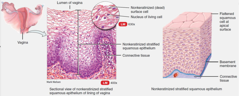 Vaginal Cancer - Causes, Signs, Symptoms, Diagnosis, Treatment