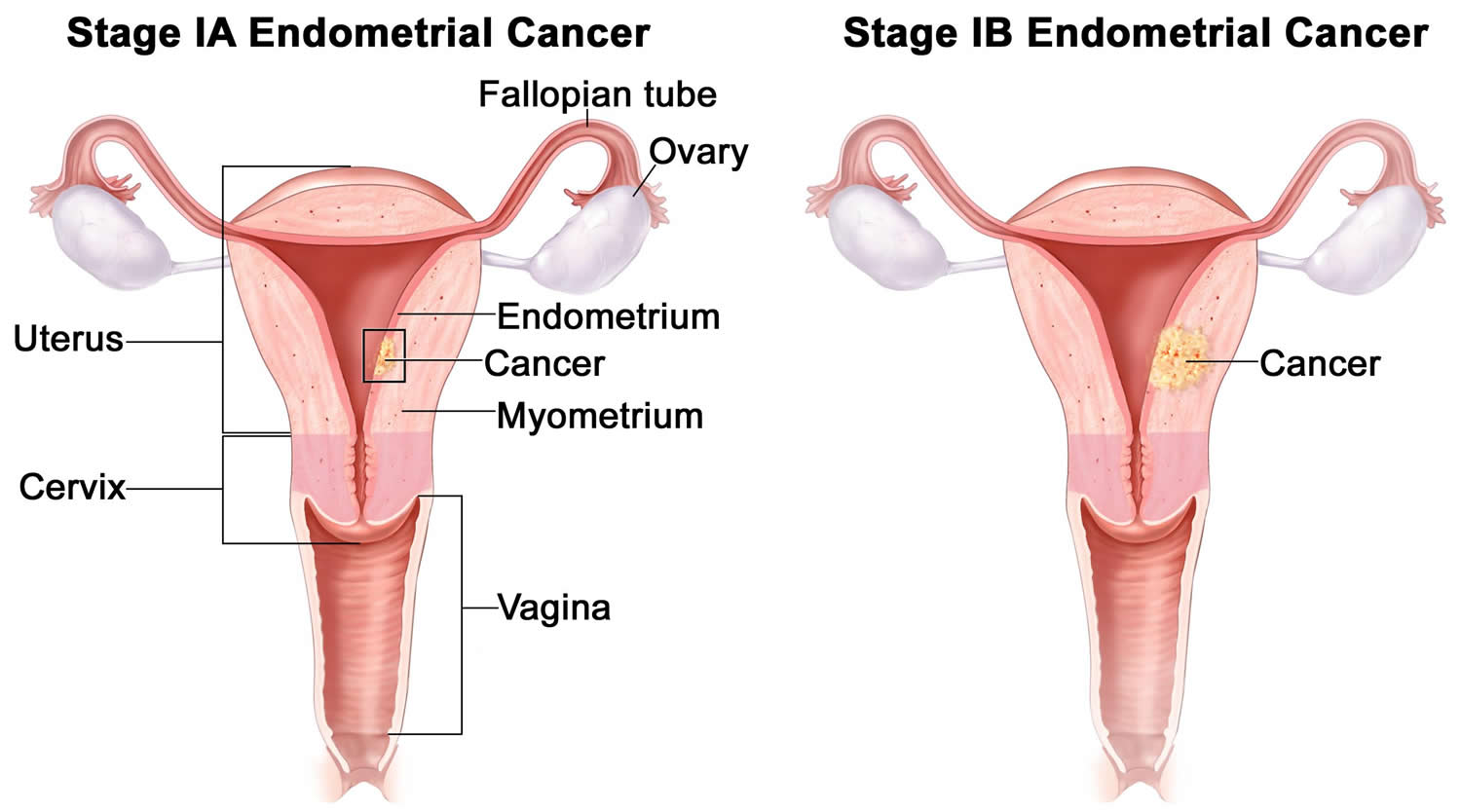 What Does Endometrial Carcinoma Mean