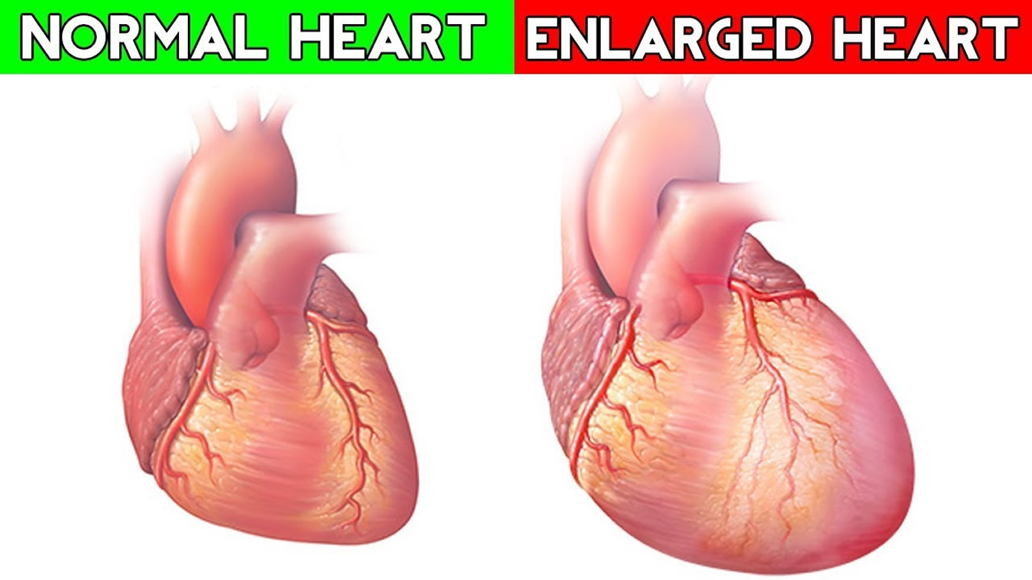 enlarged-heart-causes-signs-symptoms-treatment