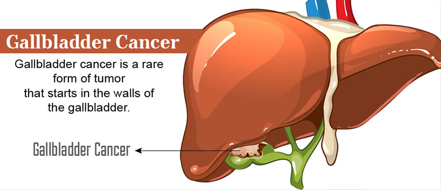 Gallbladder Cancer Causes Signs Symptoms Treatment