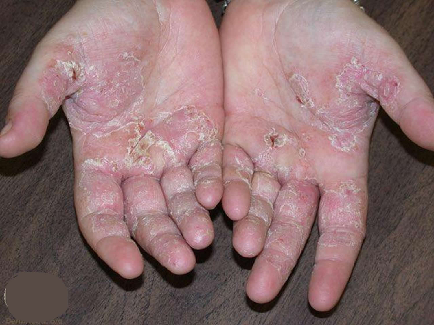 dermatitis on top of hands