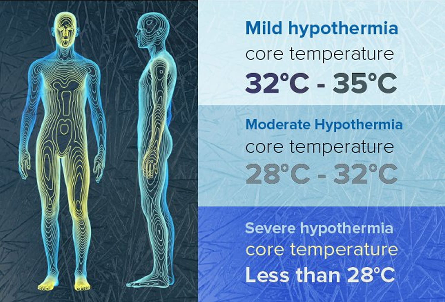 Hypothermia: Symptoms, treatment, stages, and more