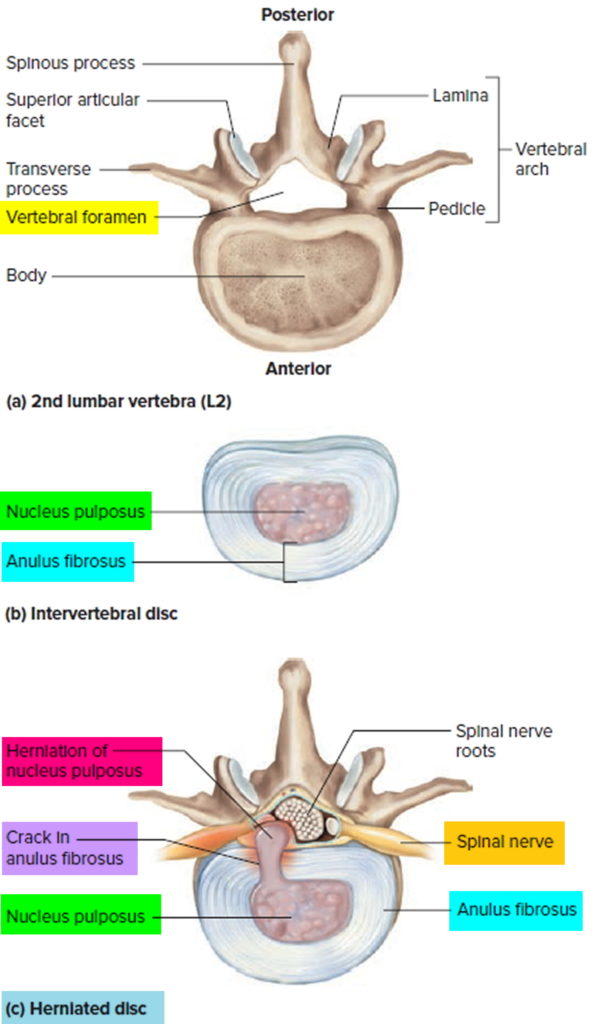 Herniated Disk - Causes, Symptoms, Exercises, Surgery, Treatment