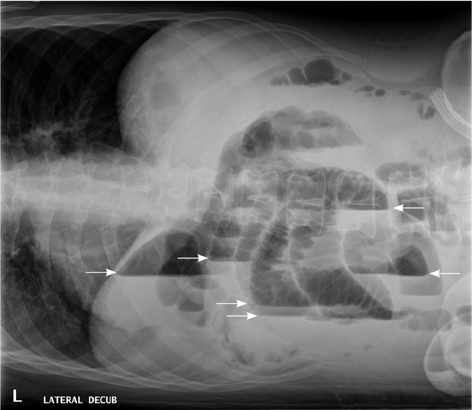 Bowel Obstruction Small And Large Causes Symptoms Treatment 7940