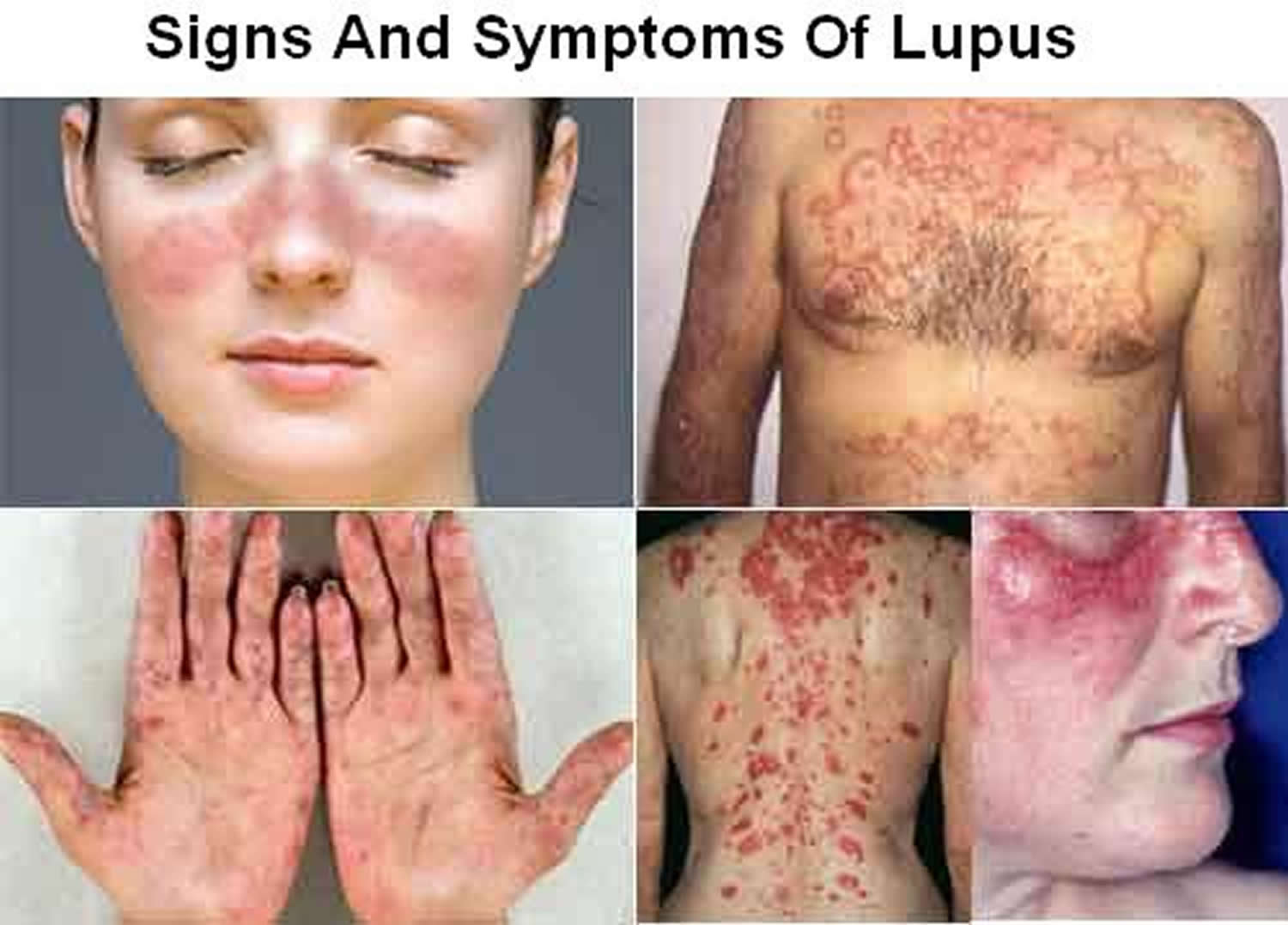 lupus-disease
