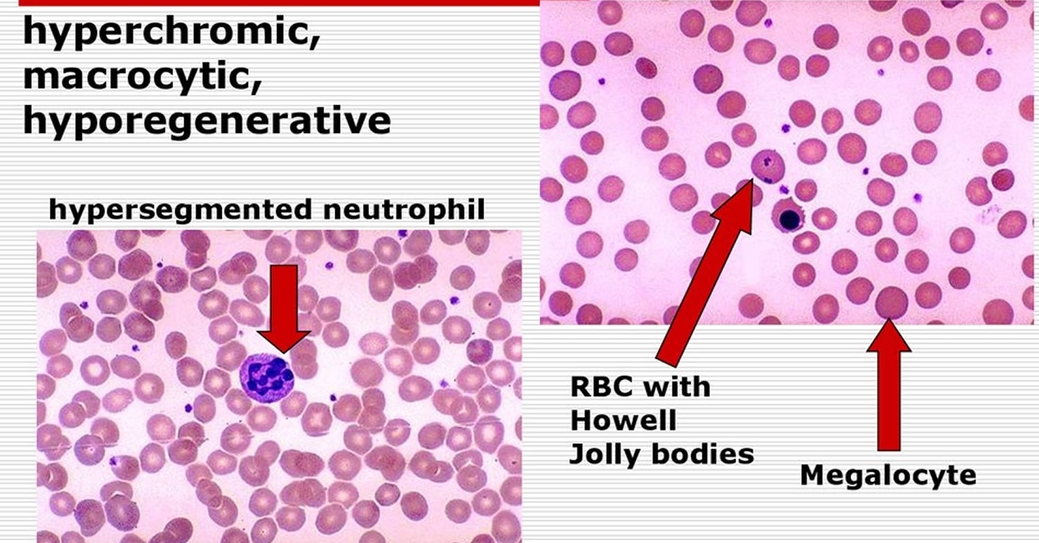 What Is Megaloblastic Anaemia Definition