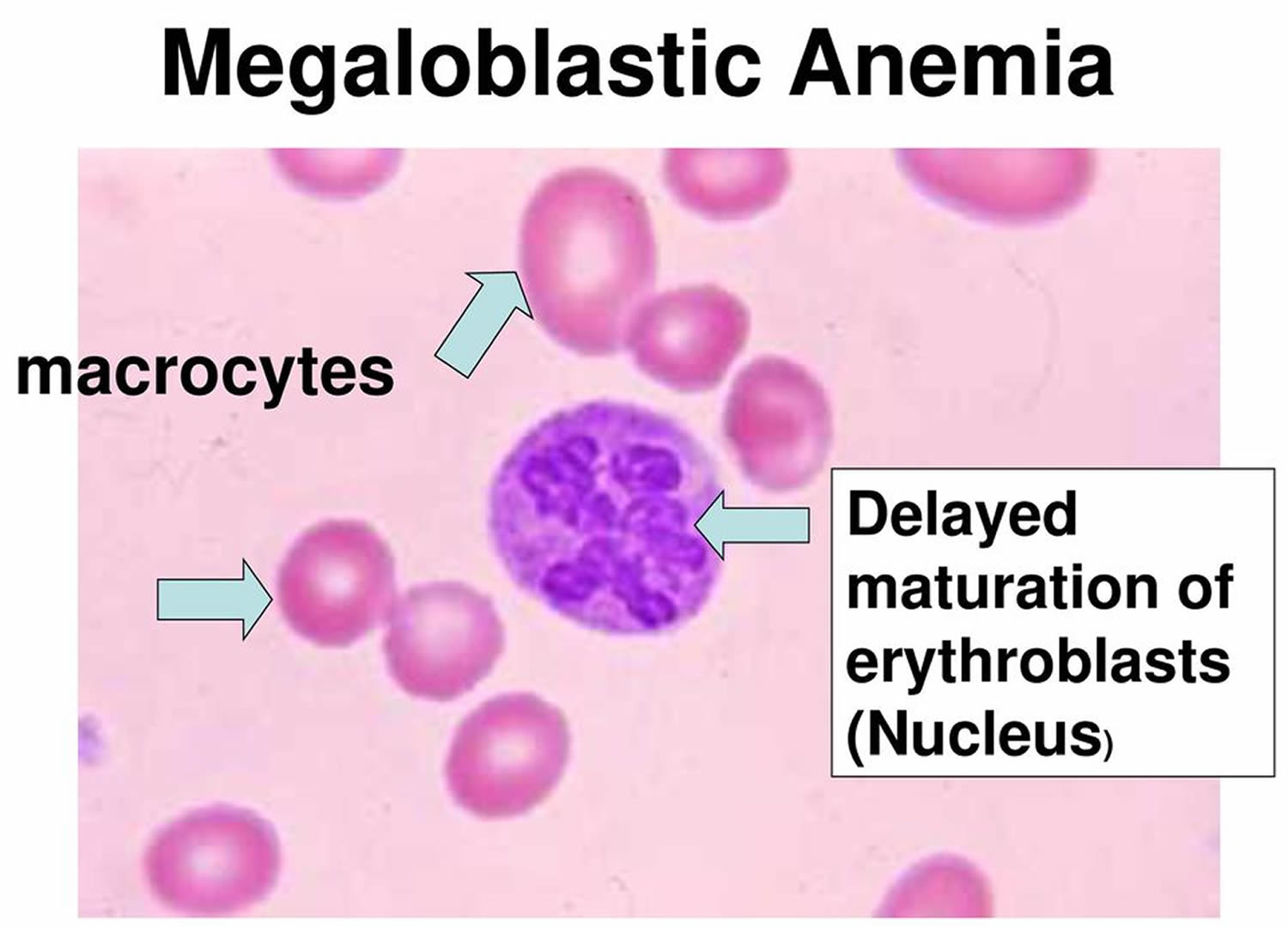 What Is Meaning By Megaloblastic Anaemia