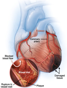 Myocardial Ischemia - Causes, Diagnosis, Symptoms, Treatment