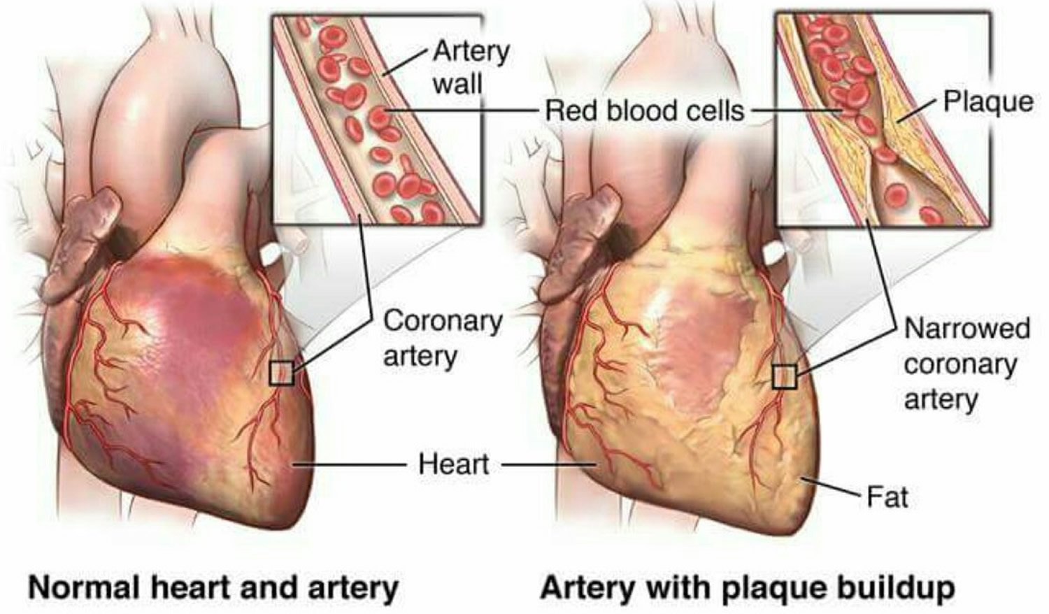 What Is Stress Induced Myocardial Ischemia