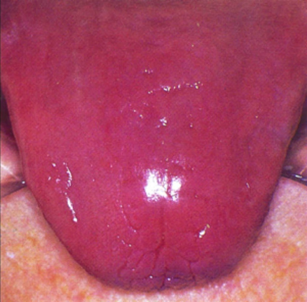 Pernicious Anemia Causes, Signs, Symptoms, Treatment