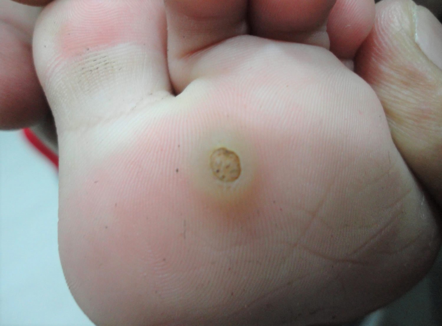 Warts Plantar Wart Wart On Finger, Hands, Face Wart Treatment